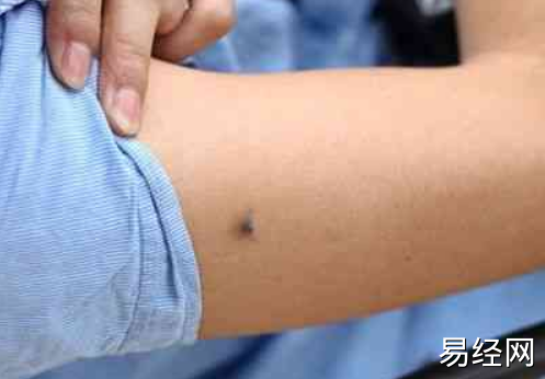 右手臂外侧有痣的女人图解 女人右手臂外侧有痣代表什么