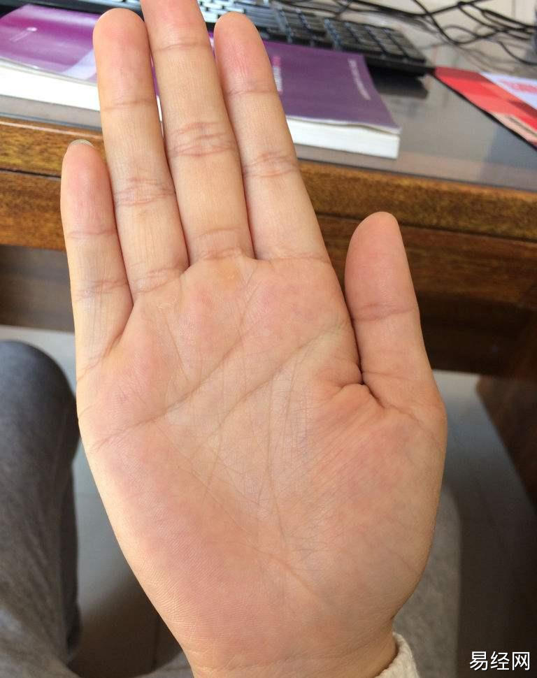 手掌有痣又有断掌说明什么?对人生有何影响?